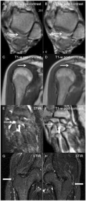 Does MRI Show Inflammation?